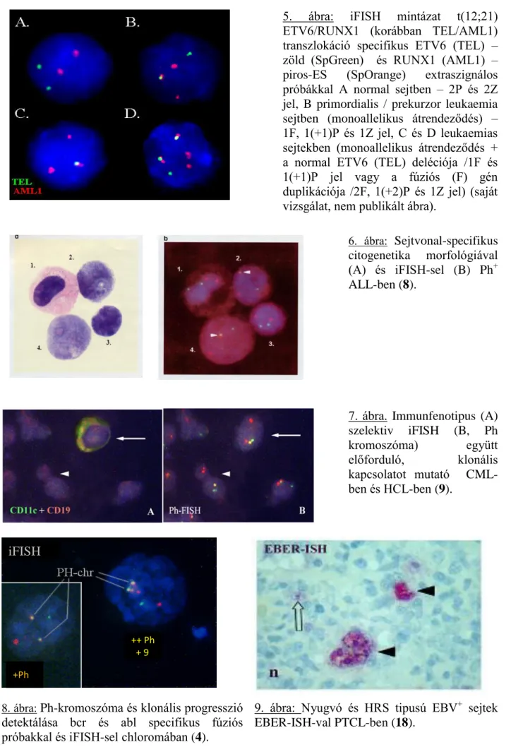 8. ábra:  Ph-kromoszóma és klonális progresszió  detektálása  bcr  és  abl  specifikus  fúziós  próbakkal és iFISH-sel chloromában (4)