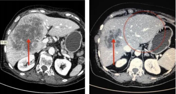 12. ábra bal kép: kezdeti alacsony, resectiora alkalamatlan volumenű bal lebeny, kiterjedt jobb oldali  tumorral, jobb kép: jelentős hypertrófiát mutató bal lebeny