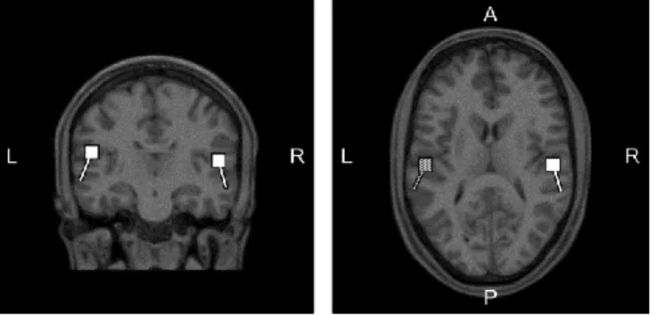 Figure 1.5.  Equivalent current dipole positions (squares) and orientiations (bars) fitted  at the N1m, superimposed on the T1-weighted magnetic resonance image (coronal- left,  axial – right) of one representative participant