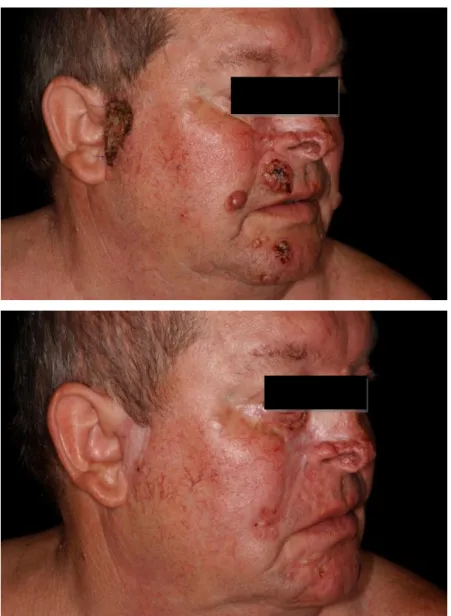 40. ábra Gorlin-Goltz szindrómában szenvedő beteg multiplex basaliomákkal az  arcán kezelés előtt és a 4