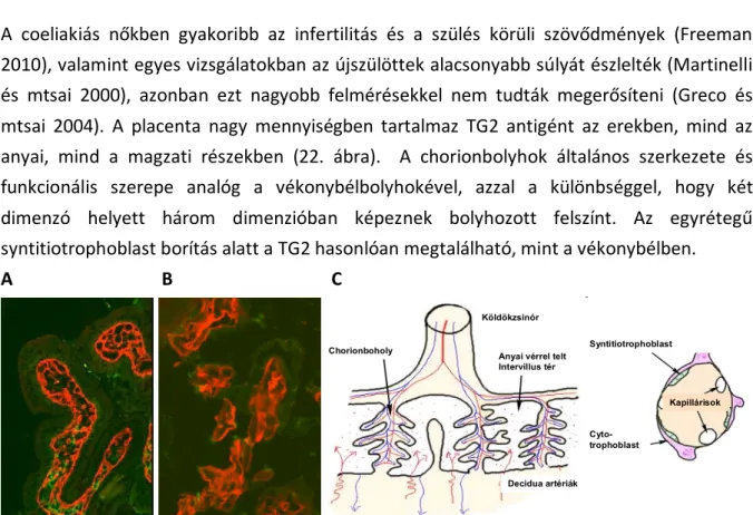 22. ábra. TG2 expresszió (piros) normál vékonybélboholyban, (A) chorionboholyban (B). IgA (zöld) a bélben csak  a plazmasejteken belül fordul elő, a placentában normálisan nem található