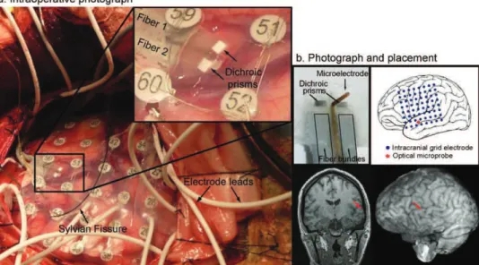 Fig. 3. (a) Intraoperative photograph of clinical grid electrodes and laminar optode. Subdural electrode arrays were placed to confirm the hypothesized seizure focus and locate epileptogenic tissue in relation to essential cortex, thus directing surgical t