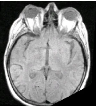 10. ábra. (49) Axialis natív TI súlyozott MR kép. A szemizmok nem vastagabbak, a  retrobulbaris köt ő szövet felszaporodott