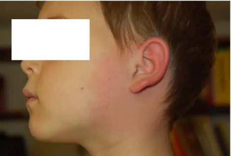 I/10. ábra. A fül körül kialakuló EM a gyermekkorra jellemző. Az EM gyakran eltűnik, és a fül duzzanata fokozódik, kialakul a BL  (lásd később)