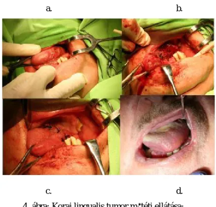 4. ábra: Korai lingualis tumor műtéti ellátása;