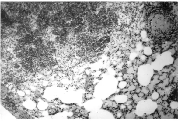 20. ábra: A GdCl 3 -dal kezelt kísérleti állatok tüdejében proliferáló insulinoma  sejteket  lehet  látni  minimális  granulocyta  és  mononukleáris  sejtekkel  a  környezetükben  (H-E  festés,  x200,  az  eredeti  dokumentáció  fekete-fehér  fotóként  kés