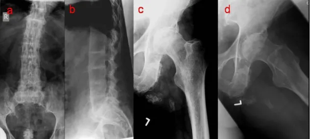 4.1.2. ábra: Az ochronosisra jellemző röntgen elváltozások 