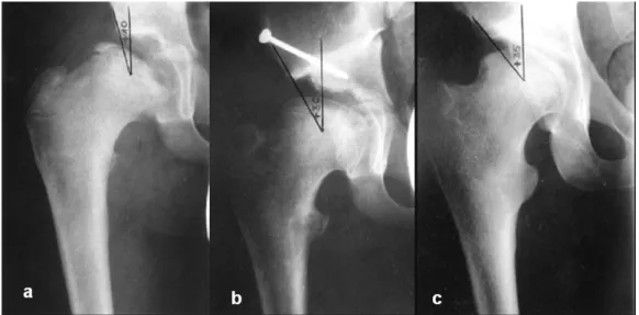 4.2.1.2. ábra: Perthes betegség miatt elvégzett Chiari oszteotómia röntgen képe 