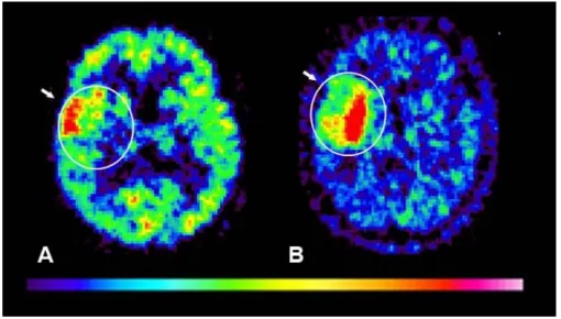 4. ábra  18 F-FDG PET (A) és  11 C-Met (B) PET transzverzális metszetképek. A metionin felvétellel jól körülhatárolt jobb oldali  frontotemporalis tumor medialis részében magas a  11 C-Met felvétel (B), míg a tumor laterális részében alacsony (nyíl, B) de 
