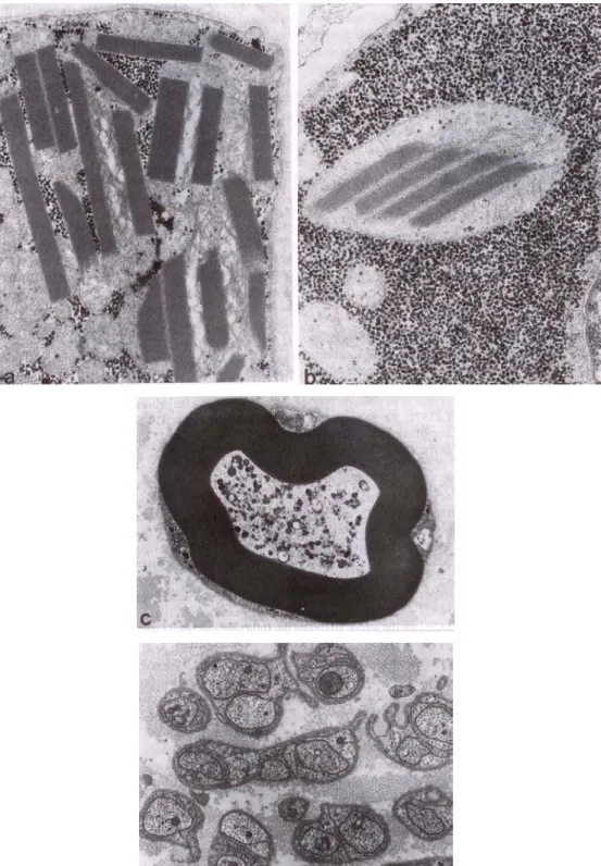 4.1. Ábra: a,) Az izombioptátumban  számos intramitochondrialis paracrystallin inclusio volt  jelen.x 23.000  b.) Nagy mennyiségű glycogen vette körül a kóros mitochondriumokat X 30.000  C