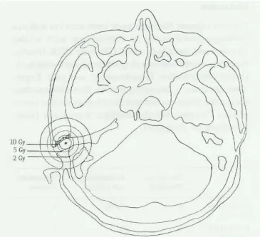 5. ábra Co 60  LDR manuális brachyterápia dóziseloszlása a külsı hallójáratban 