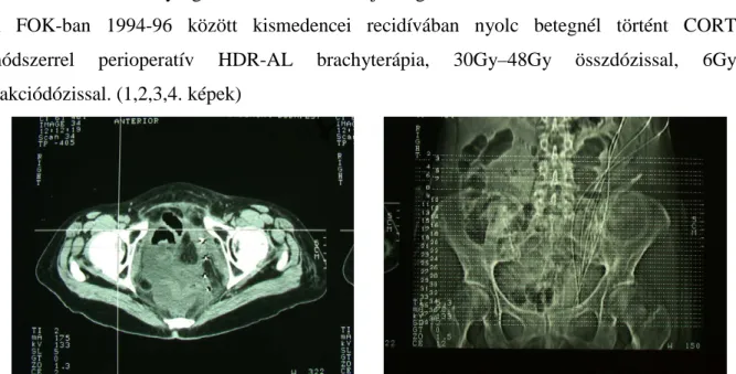       1. és  2. kép Kismedencében, a rezekció vonalába helyezett HDR-AL brachyterápiás katéterek vizualizációja          haránt irányú CT metszeten és szummált CT képen