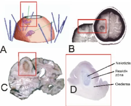 13. ábra. A  hármas gy r  patológiai és MRI képe besugárzás után. Illusztratív eset  ismertetés 