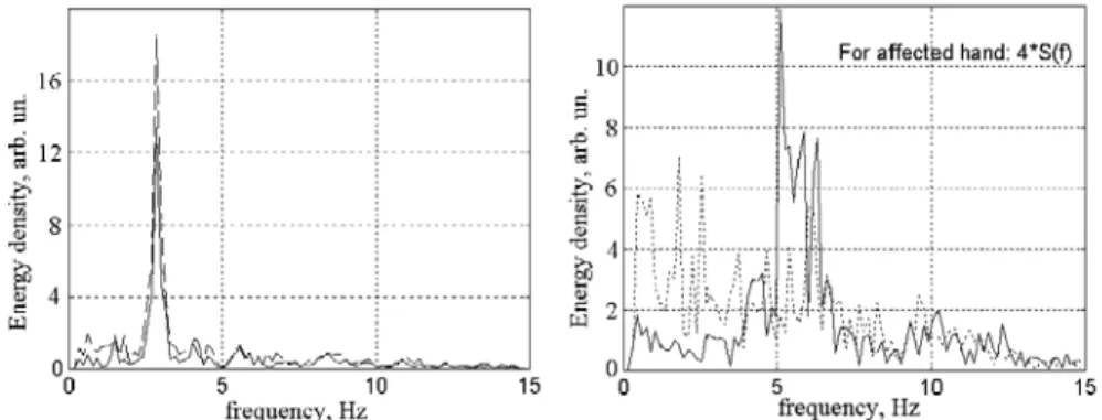 Figure 1.9. Frequency spectra of time functions of both index fingers of a young healthy patient (left) and  of a Parkinsonian patient (right, affected hand: dotted line) during tapping test