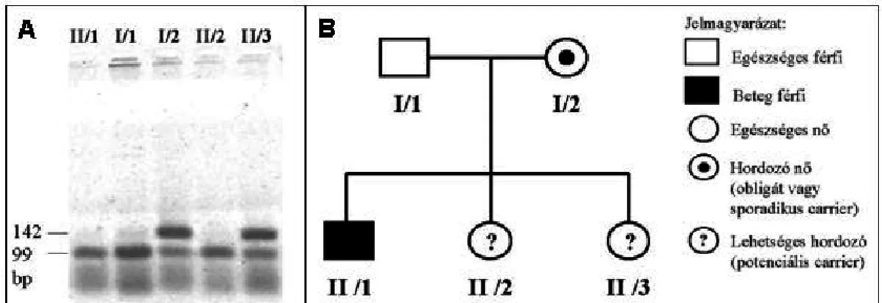 3. ábra: Családvizsgálat BclI-PCR-RFLP elemzéssel (1. család). A panel:  Az emésztett PCR  termékek agaróz gél-elektroforézise után kapott gél képe;  B panel:  Családfa és a hozzá tartozó jelmagyarázat