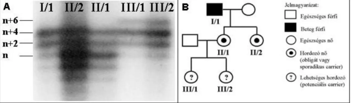 4. ábra: Családvizsgálat IVS13CA mikroszatellita elemzéssel (2. család). A panel:  a radioaktívan  jelölt PCR termékek poliakrilamid gél-elektroforézise után a gélről készült autoradiogram képe;  B panel: