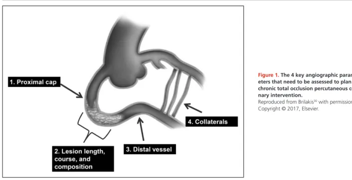 Figure 1. The 4 key angiographic param- param-eters that need to be assessed to plan  chronic total occlusion percutaneous  coro-nary intervention