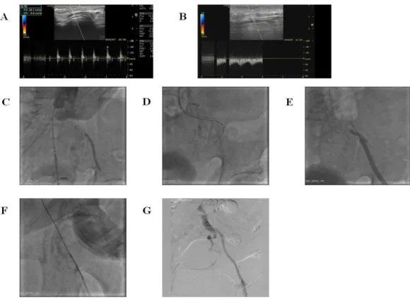 Figure 2: A - Punction of the left distal radial artery (snuff-box). B - Punction of the left posterior tibial artery