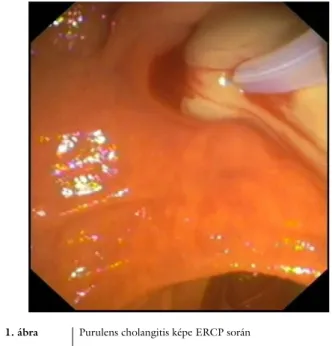 1. ábra Purulens cholangitis képe ERCP során 