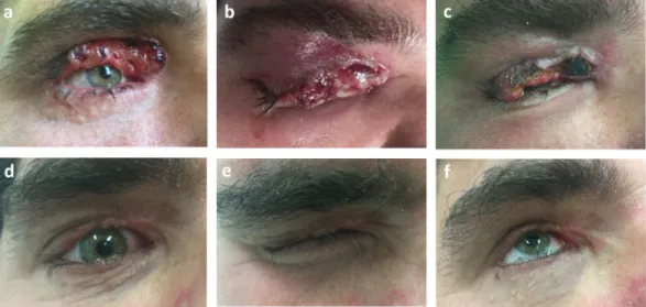 Figure 1.  Electrochemotherapy (ECT) in the treatment of primary upper eyelid basal cell carcinoma (patient  No 1)
