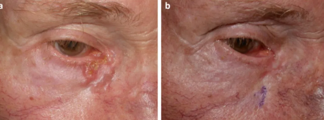 Figure 3.  Recurrent basal cell carcinomas on the right lower eyelid and nasal area (patient No 5)