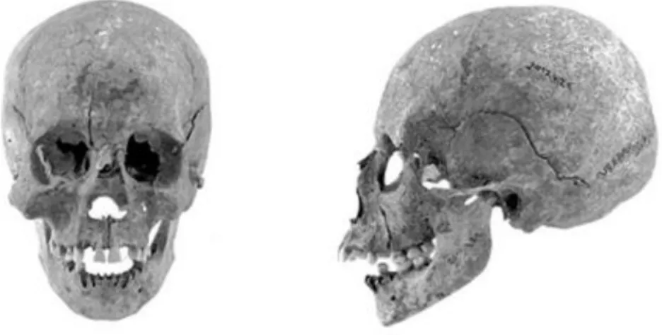 3. ábra: Egy 19–22 éves nő (Kehida-Fövenyes, 21. sír, ltsz: 2017.4.21) koponyája elől- és  oldalnézetben – pamíri-X (mongoloid) 