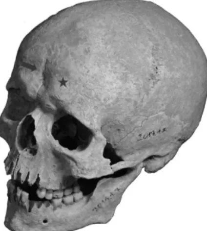 10. ábra: Egy 30–40 éves férfi homlokán a perzisztáló sutura  metopica (nyíl) vonalában depresszió figyelhető meg, a csillag 