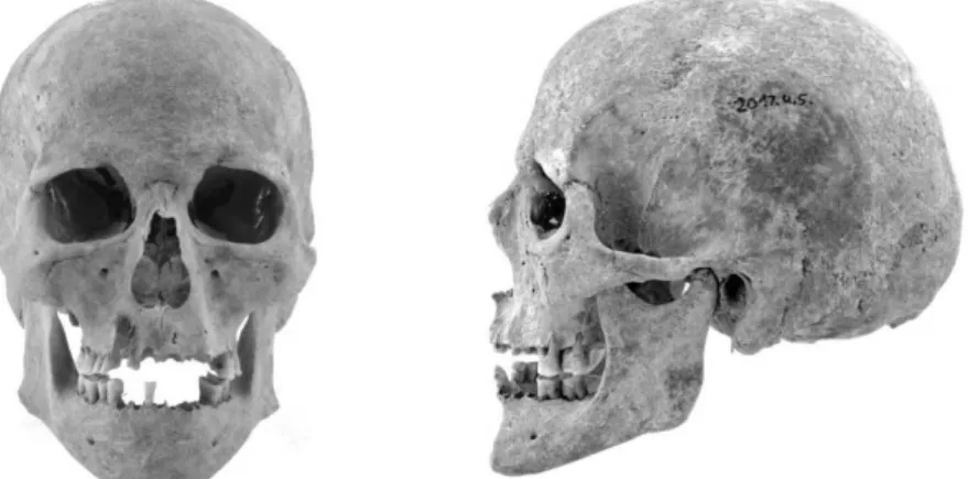 2. ábra: Egy 40–45 éves férfi (Kehida-Fövenyes, 7/A. sír, ltsz: 2017.4.5) koponyája elől- és  oldalnézetben – cromagnoid-A 