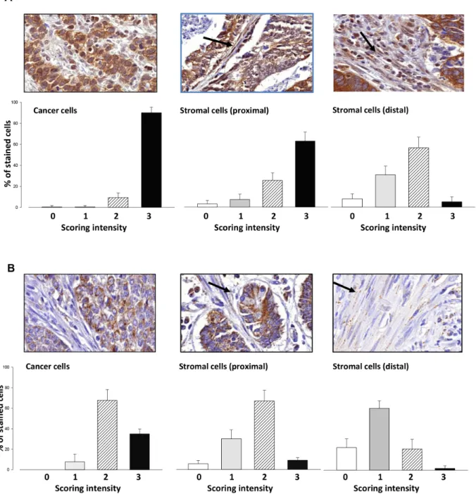 Figure 1: Expression of CMKLR1 and GPR1 in gastric cancer.  (A) Immunohistochemical localization of CMKLR1 in gastric  tumors (top panels) and quantification in lower panels based on the proportion of cells in each compartment scored 0 – 3 for intensity; 