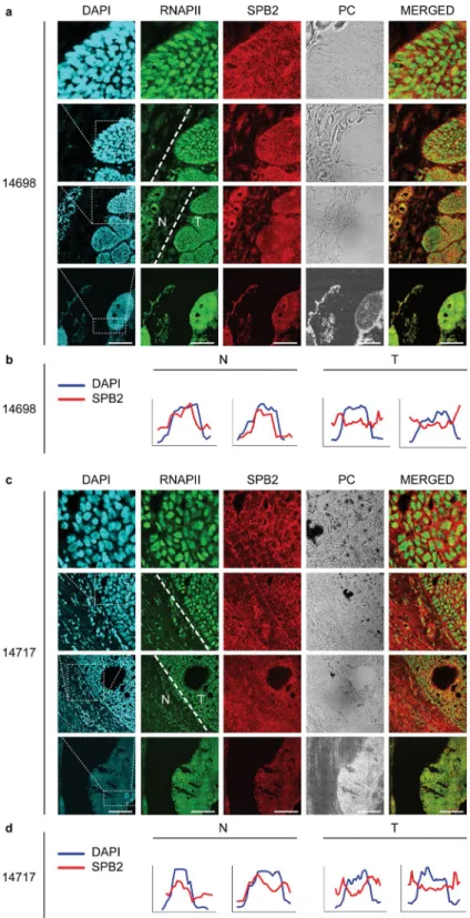 Figure 5.  Subcellular localization of SPB2 in the normal and tumorous part of human skin tissues: (a,c)  co-immunostaining with RNA Polymerase II (RNAPII) (green) and SPB2 (red) in normal and in basal  cell carcinoma tissues