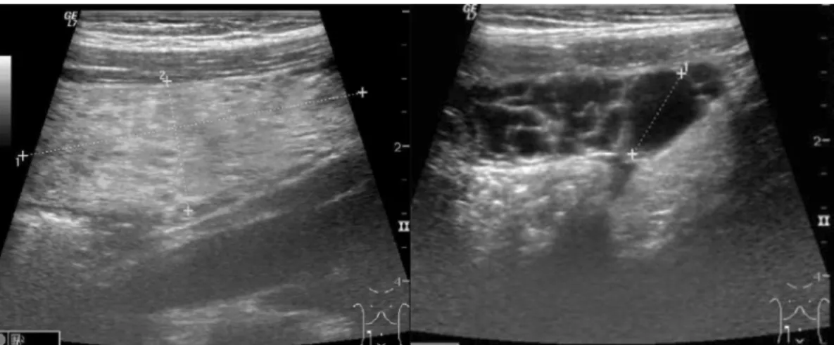 Figure 1 Band-like cystic mass seen on the follow-up ultrasound.
