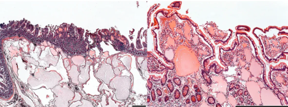 Figure 3 Microscopic picture showing typical changes for pIL: dilated lymphatics in subserosa, submucosa and lamina propria.
