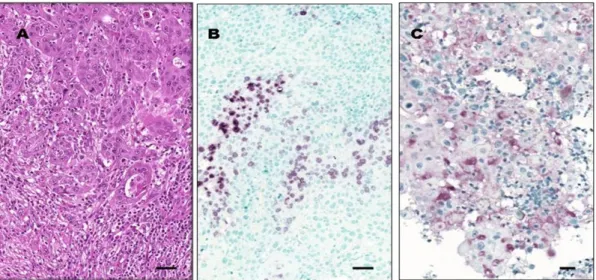 Figure 2. IL-6 protein expression in OSCC tumor tissue. Images from a representative tissue sample 