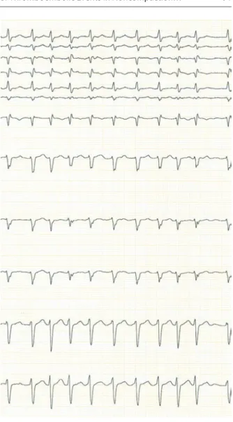 Fig. 6.5 Routine  electrocardiography  demonstrating high  frequency atrial fibrillation