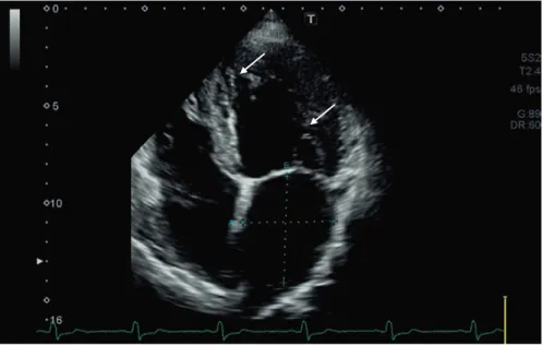 Fig. 6.6  Routine 2-dimensional echocardiography demonstrating hypertrabecularization of the  LV apex with intertrabecular recesses
