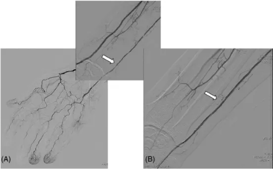 FIGURE 1 Angioplasty in chronic critical hand ischemia. A, High grade stenosis of the right ulnar artery (white arrow) in a patient with a chronic renal failure and diabetes mellitus