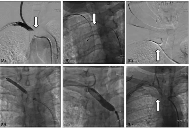 FIGURE 2 Subclavian artery CTO recanalization. A, Subclavian artery angiography from right radial artery access showing anonym artery CTO (white arrow)