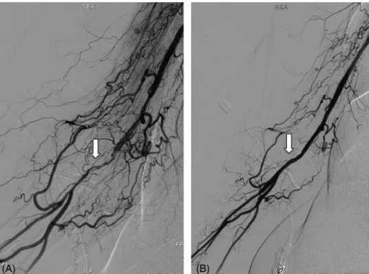 FIGURE 3 Brachial artery CTO recanalization. A, Brachial artery angiography shows a brachial artery CTO with highly developed collateral system (white arrow)