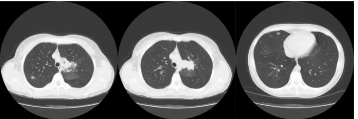 1. ábra Mellkas-CT: Jobb oldali kép: laesio a jobb felső tüdőlebenyben. Középső kép: laesio a bal felső tüdőlebenyben