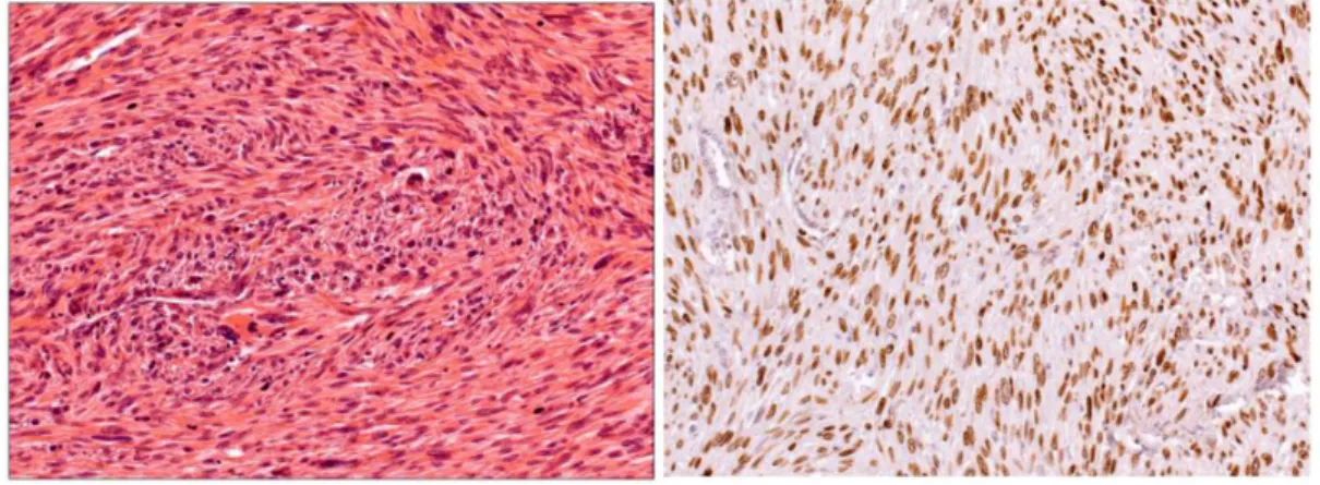 2. ábra Bal oldal: bal felső tüdőlebeny reszekátuma (az anya kronológiailag első tumora): primer pulmonalis leiomyosarcoma, mely összefonódó kötegekbe  rendeződött orsósejtekből áll (He, 20×)