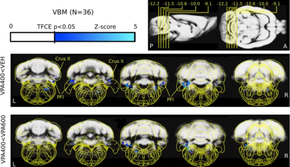 Figure 1.  Decreased cerebellar and brainstem gray matter density revealed by voxel-based morphometry  analysis