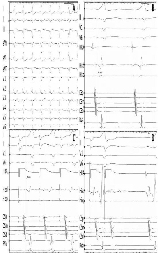 Figure 2. Surface electrocardiogram lead I, II, V 1 , V 6  along with intracardiac recordings from high  right atrium (HRA), coronary sinus (CS), right ventricular apex (RV) and ablation catheter (Abl) during 