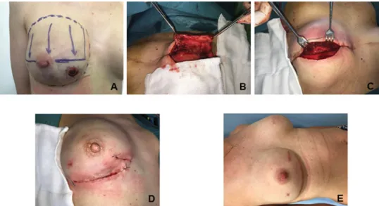 FIGURE 1. Photo documentation of the surgical intervention. A: A patient selected for capsu- capsu-loplasty