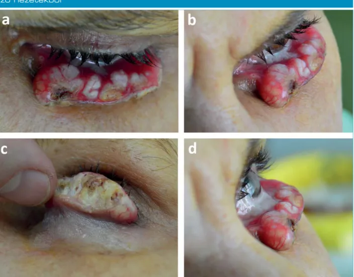 1. ábra (a–d): A bal alsó szemhéjat destruáló óriás keratoacanthoma különbö- különbö-ző nézetekből