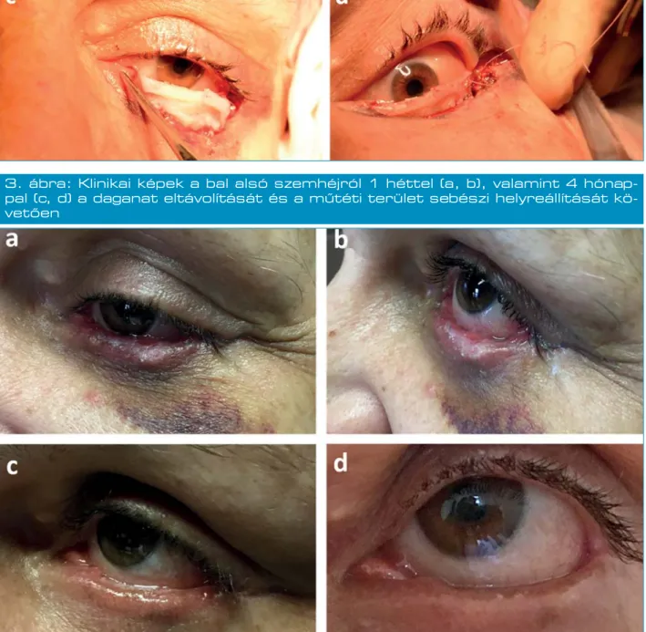 3. ábra: Klinikai képek a bal alsó szemhéjról 1 héttel (a, b), valamint 4 hónap- hónap-pal (c, d) a daganat eltávolítását és a műtéti terület sebészi helyreállítását  kö-vetően