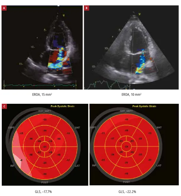 Figure 1  Stress echocardiography of a 56-year -old woman with mitral valve prolapse and uncertain symptoms