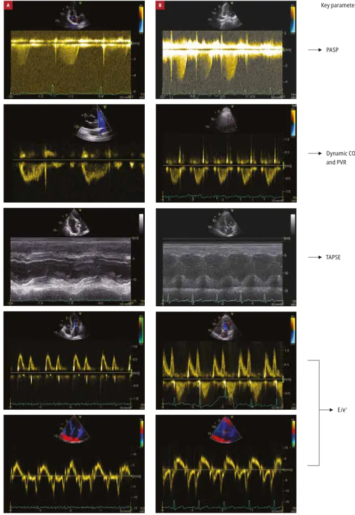 Figure 4  Assessment of right ventricular pressure, noninvasively measured dynamic pulmonary vascular resistance (PVR), tricuspid annular plane systolic  excursion (TAPSE), and left ventricular filling pressure in patients at risk of pulmonary hypertension