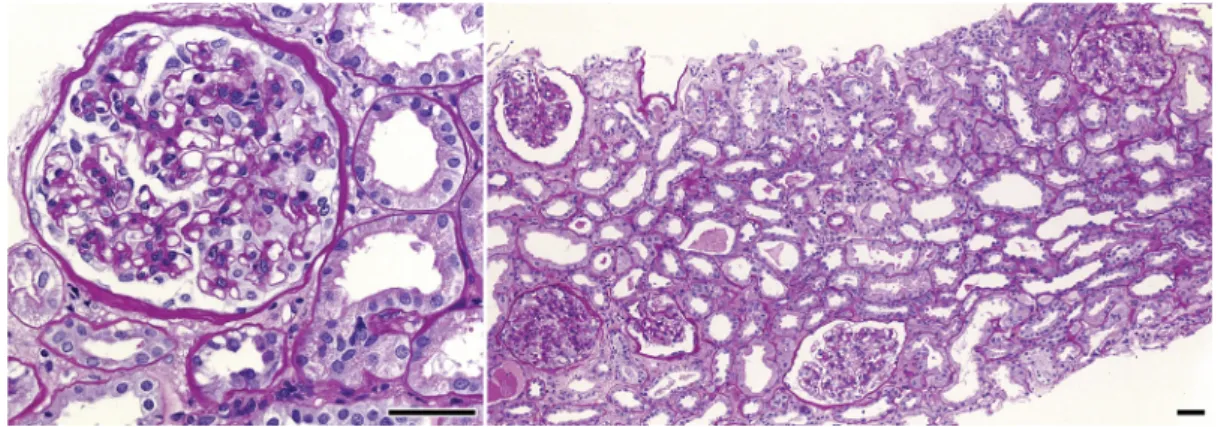2. ábra Fénymikroszkópos észleletek. Bal oldal: enyhe mesangialis sejtproliferatio a glomerulusban (perjódsav-Schiff, nagyítás: ×40; lépték: 50 μm); jobb ol- ol-dal: enyhe proliferativ glomerularis laesio, fokális és enyhe interstitialis fibrosis, tubulus 