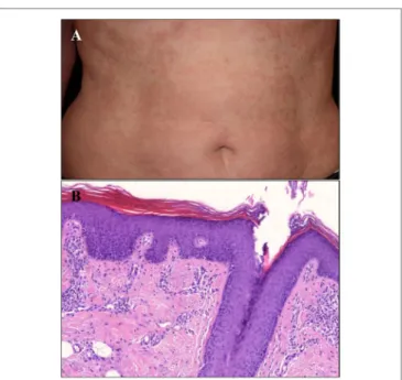 FIgURe 1 | Clinical and histological image of the type V Pityriasis rubra pilaris  (PRP) patient