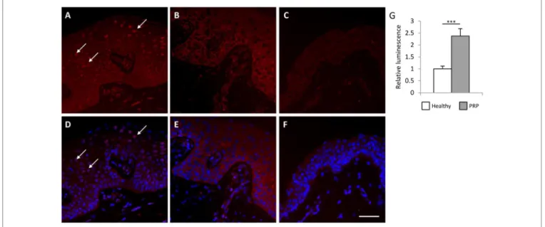 FIgURe 2 | Lesional Pityriasis rubra pilaris (PRP) skin samples and keratinocytes exhibit higher nuclear factor  κ B (NF κ B) activation compared to healthy samples